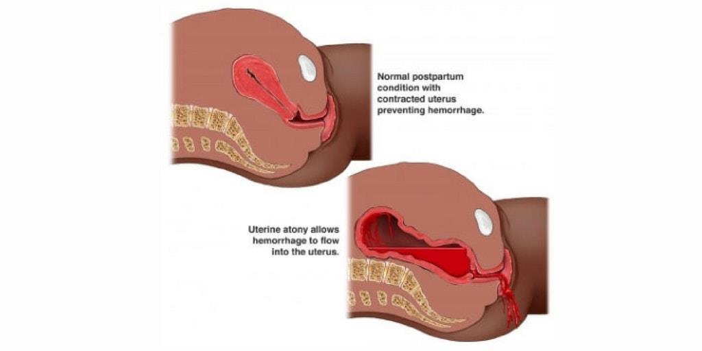 Hypotonie po