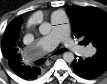 Truncus pulmonalis = plícnice sinus trunci pulmonalis (dx., sin., ant.