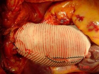 Aneurysma aortae