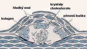 Klinické poznámky ateroskleróza = kornatění ve vyspělých státech je příčinou 50 % úmrtí kombinace změn tunica intima tepen + ukládání