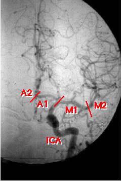Části mozkových tepen a. cerebri ant. pars precommunicalis; segmentum A1 pars postcommunicalis; segmentum A2 a.