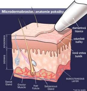 Mikrokrystalová dermabrase a biostimulační laser Toto ošetření odstraní vrchní vrstvu pokožky s odumřelými buňkami, zatímco paralelně působící biostimulační laser stimuluje regenerační a hojivé