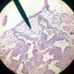 Ti jedinci, kteří byli vystaveni diethystilbestrolu v matčině děloze, tak mohou mít abnormality svých rozmnoţovacích orgánů.