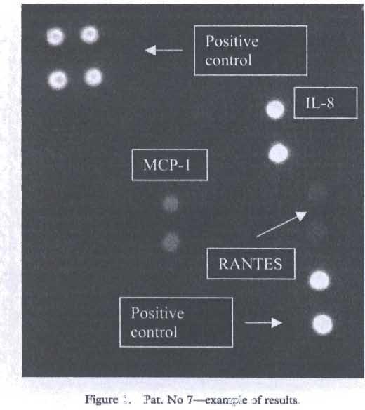 Our resul are in agreement with utoantibody status and type 1 diabctes ri k genotyp.