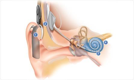 Kochleární implantát 1. Řečový procesor zachytí zvuky a předá je cívce (č. 2).