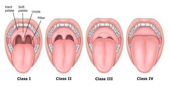 OBTÍŽNÁ INTUBACE V TĚHOTENSTVÍ 10x vyšší riziko obtížné intubace se v průběhu