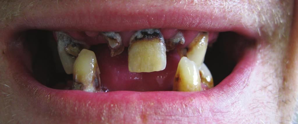 Obr. 1 Obr. 3 Obr. 2 Obr. 1: Stav v ústech pacienta před extrakcí Obr.