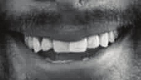 (kombinační tabulka velikostí konfekčních zubů) vybral nejvhodnější výchozí tvar konfekčních zubů, a to Super Lux A2V 1/27. Pacienta jsem si vyfotil, včetně detailů jeho zbylých zubů (obr. 1).