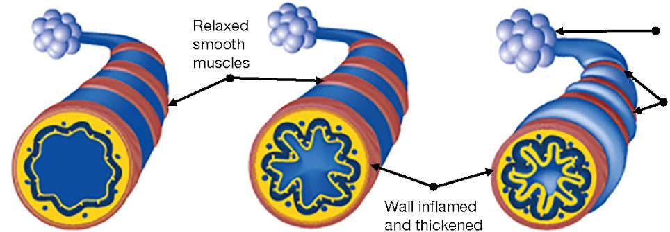 Asthma bronchiale Akutní záchvat exacerbace - zhoršení Relaxed smooth muscles Air trapped in alveoli Constricted