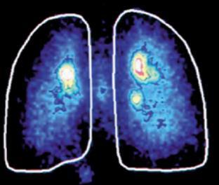 Asthma bronchiale léčba a Plicní depozice inhalační systémy množství léku (%), které se dostane do plic a vyvolá účinek.