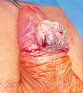Man, 73-year-old, squamous cell carcinoma of the penis pt1g2 pn1 (right groin), treated with excision and radical ilioinguinal lymphadenectomy strana 202 levulinát 16% krém Metvix ) a vše se pokryje