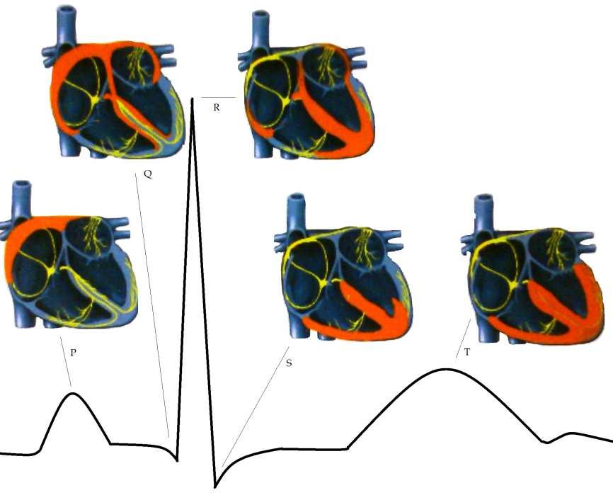 Vlna T je známkou repolarizace komor. Souvislost srdeční aktivity se signálem EKG je znázorněna na obrázku (Obrázek ). Šíření vzruchu v srdci je zde naznačeno červenou barvou.