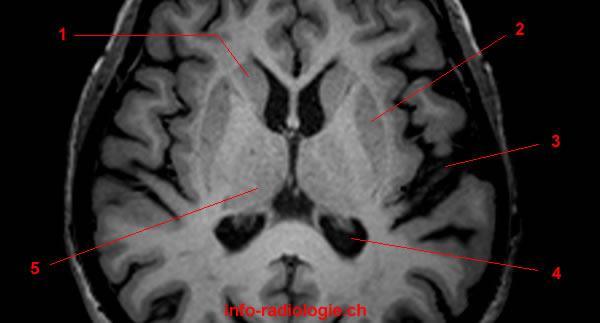 BG T1-weighted axial cut. 1.Caudate nucleus 2. Putamen 3.