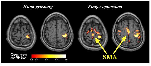 Suplementární motorická area (SMA) Porovnání aktivace SMA při jednoduchém pohybu zvýšená aktivita v kontralaterální A4 při složitějším motorickém úkolu - aktivace jak