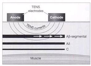 Obrázek 2 Mechanismus působení aplikace TENS proudů (Kitchen, Bazin, 2009) Endorfinová teorie tlumení bolesti Aktivace periferních receptorů nejrůznějšími podněty vede k uvolnění endogenních