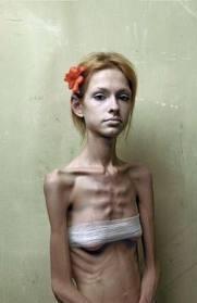 Mentální anorexie (anorexia nervosa) váhový úbytek, dosahovaný úmyslně restriktivní techniky (dieta, nadměrné cvičení) purgativní techniky (zvracení, užívání laxativ, diuretik) narušené vnímání