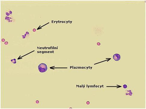 2.5.2. Morfologie plazmatické buňky Za patologických okolností dochází k přeměně buněk lymfocytární řady ve velké lymfocyty, u buněk B-lymfo dále ještě v lymfoplazmocyty a v buňky plazmatické.