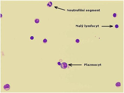 Obrázek 7: Plazmocyt, neutrofilní segment, lymfocyty, barveno MGG, zvětšení 20 x 10, archiv OKB, Krajská nemocnice Liberec, a. s. Hodnocení: V normálním cytologickém nálezu likvoru se nachází lymfocyty a monocyty ve vzájemném poměru přibližně 7:3 s tolerancí do 10% aktivovaných lymfocytů.