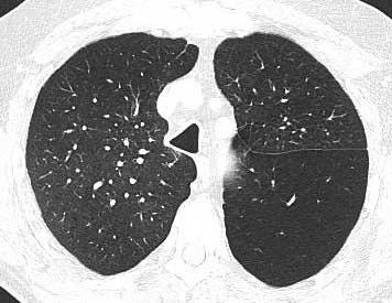 -2,33% +obturace laloku EBV -30,3% 12,4% 6,3% -3,34% + CV negat.