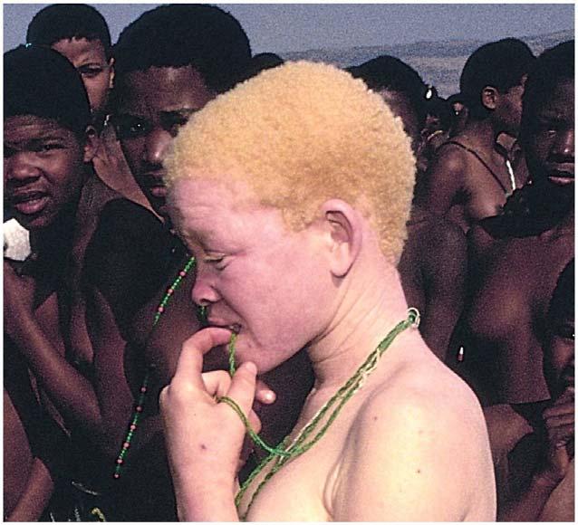 Př. 2: Albinismus se vyskytuje v populaci
