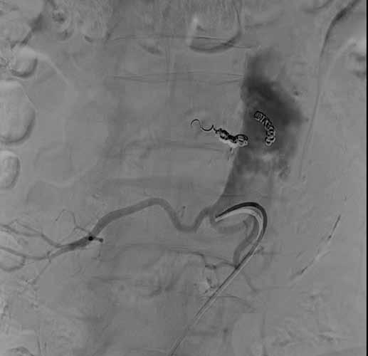 Obr. 1B Obr. 1A Obr. 1C Obr. 1D Obr. 1. Předoperační embolizace lumbálních tepen u 60letého muže s asymptomatickým AAA. A selektivní angiogram lumbálních tepen L4 oboustranně.