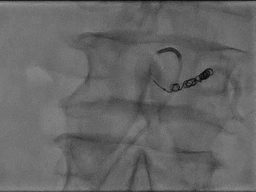 lumbální tepnu L3 vpravo; D kontrolní CT angiografie, stav po úspěšném zavedení bifurkačního stentgraftu, není patrný endoleak, vak aneurysmatu zmenšen. Šipka ukazuje spirálky v lumbálních tepnách L4.