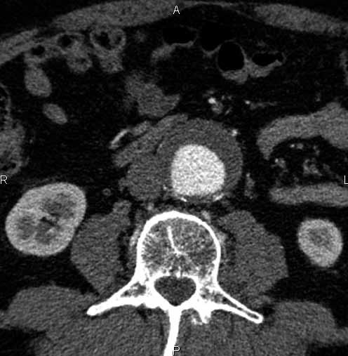 Coils in embolised lumbar arteries L3 (arrows); B detail of the coil in the left lumbar artery L4; C preoperative CT examination, AAA with intraluminal thrombus, arrow shows the right lumbar artery