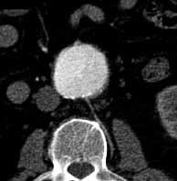 Obr. 2A Obr. 2B Obr. 2C Obr. 2. Embolizace endoleaku v průběhu sledování. 82letý muž s rostoucím aneurysmatem břišní aorty (pacient 33), axiální CT vyšetření.