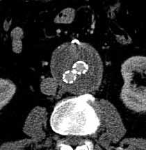 a endoleak (šipky); C CT vyšetření rok po embolizaci dolní mezenterické tepny spirálkou (šipka), došlo k vymizení endoleaku a stabilizaci velikosti vaku aneurysmatu Fig. 2.