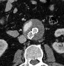 A preoperative examination revealed endoleak, arrow shows non-embolised left lumbar artery L3; B CT scan one year after stentgraft implantation demonstrates enlargement of aneurysmal sac and endoleak