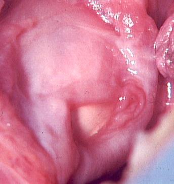 occlusion Antiaspiration