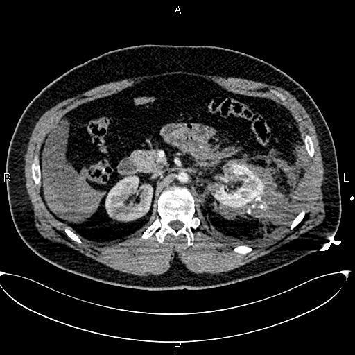 Hemoperitoneum Venozní fáze Siemens Somatom