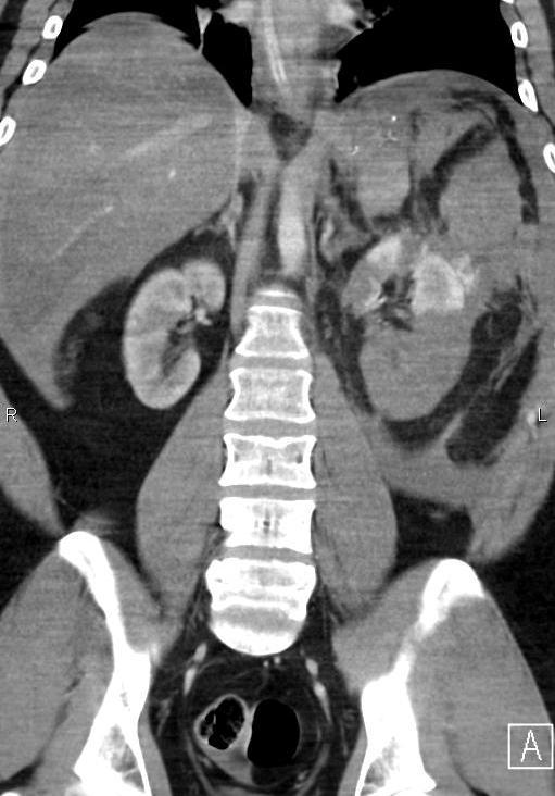 Lacerace sleziny Hematom subfrenia Hemoperitoneum Lacerace