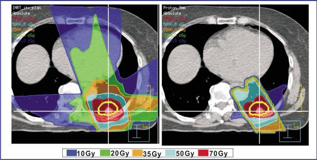 Obrázek 13 Srovnání plánu fotonové terapie s modulovanou intenzitou svazku (vlevo) a plánem protonové terapie (vpravo) 12 Obrázek 14 Křivky distribuce