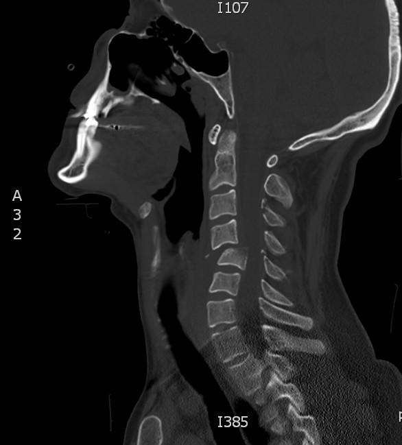 ATLSaDiskbilitvy Rychlé zhodnocení neurologického nálezu stav vědomí na velikost a reakci zornic potenciální poranění páteře (popis motoriky a senze) AVPU (Alert,