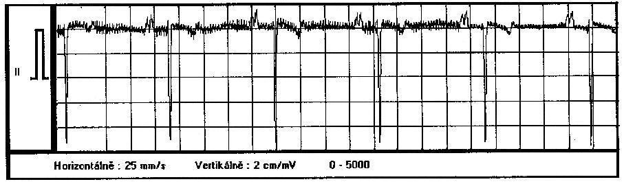 Obr. 4 Síťové rušení signálu EKG 3.2. Širokopásmové signály Širokopásmové signály jsou tvořeny myopotenciály, pohybovými artefakty, rychlými skokovými změnami izoelektrické linie a impulsním rušením.