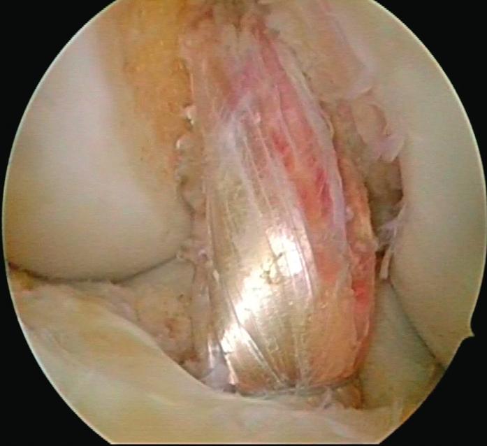 Pohled z ALP před společným vytažením protahovacích vláken (femorálnímodré vlákno, tibiální- zelené vlákno) ven z