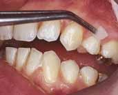 / nebo obroušení Abradované okluzní plošky a zuby zatížené sponami Po úrazech skloviny (např.