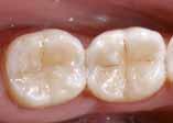 třídy Rekonstrukce frontálních zubů poškozených úrazem Fazetování diskolorovaných frontálních zubů Úpravy tvaru a odstínu z důvodu zlepšení estetiky Imobilizace, dlahování uvolněných frontálních zubů