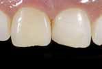 uvolněných zubů Opravy fazet Výplně v mléčném chrupu Dostavby pahýlů pod korunky Kompozitní inleje Výplňový materiál v barvě zubu pro spolehlivé výplně Vysoký obsah plniva, 89 %
