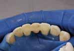 provizornímu ošetření po extrakci a náhradě chybějícího zubu zubem umělým K provizornímu nebo dlouhodobě provizornímu držení místa