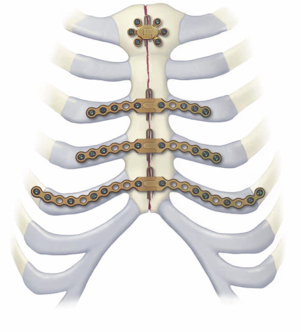 Titanový sternální fixační systém Stabilní interní fixace hrudní kosti pro její rekonstrukci Titanový sternální fixační systém zajišťuje stabilní interní fixaci hrudní kosti pro