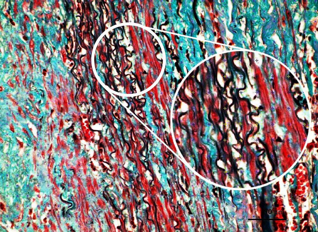 6 Metodiky 6.1 Metodika histopatologické kvantifikace lidských AAA Ve studii [Eberlová et al.
