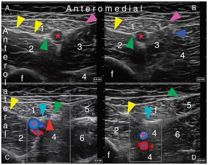 FEMORAL TRIANGLE BLOCK The ultrasonographic visualization of the neurovascular bundle inside the FT. A, Femoral triangle, midway between the ASIS and base of patella.