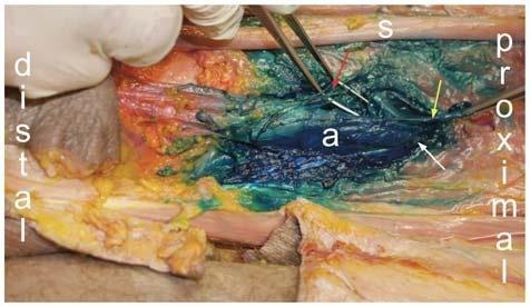 (yellow arrow), adductor hiatus (white arrow). Coloring of nerve branches inside the popliteal fossa.