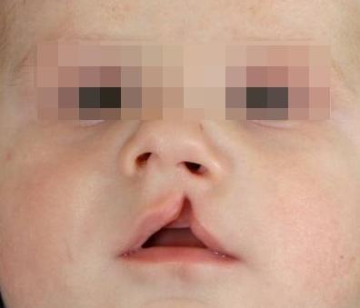 3.6 Morfologie střední obličejové etáţe novorozence s rozštěpovou vadou Střední obličejová etáţ novorozence s rozštěpem vykazuje specifické morfologické znaky dané atypiemi během intrauterinního