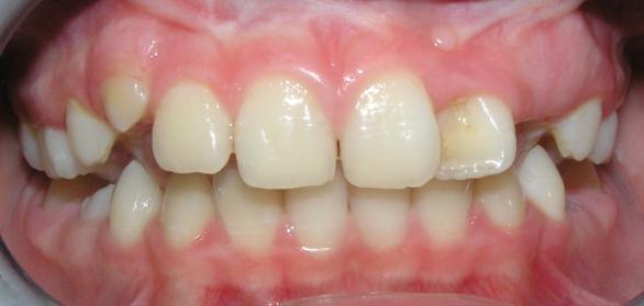 Stabilizace celého stavu pomocí dlouhodobě mírně aktivních ortodontických aparátů a pravidelné kontroly jsou optimální.