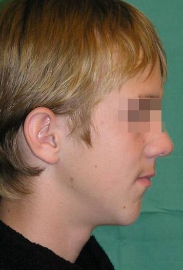 Syndrom krátkého patra nevede během růstu ke zjevné deformaci obličeje.