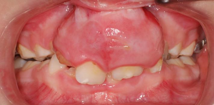 celkovým rozštěpem po dokončení růstu podstupují kombinovanou chirurgickoortodontickou léčbu. Horní zubní oblouk u pacienta s jednostranným celkovým rozštěpem postupně získává typický vzhled (obr.