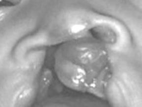30 A,B,C: Modifikovaná moldingová deska s nosními vzpěrami pouţívaná na Oddělení ortodoncie a rozštěpových vad FNKV a fotografie pacienta A - před, B - po nasoalveolárním moldingu; černé šipky tvar
